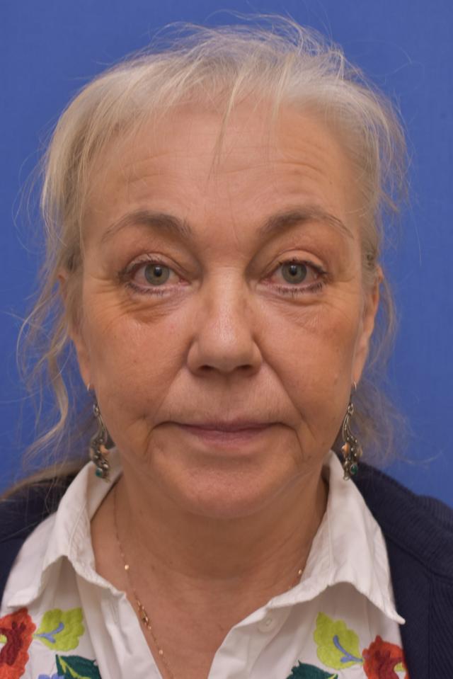 Blepharoplasty after at Liebertz Plastic Surgery at Yarrow Bay in Kirkland, WA