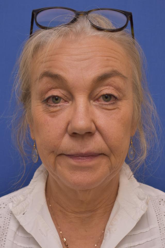 Blepharoplasty before at Liebertz Plastic Surgery at Yarrow Bay in Kirkland, WA