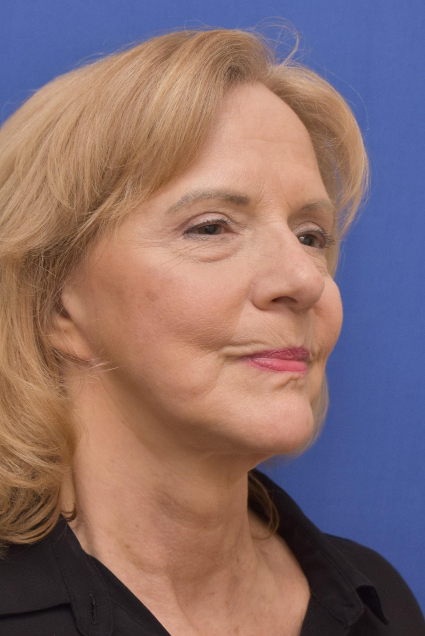 Liebertz Plastic Surgery at Yarrow Bay facelift after — Kirkland, WA