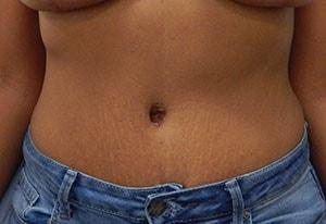 Hurvitz Plastic Surgery tummy tuck after — Torrance, CA