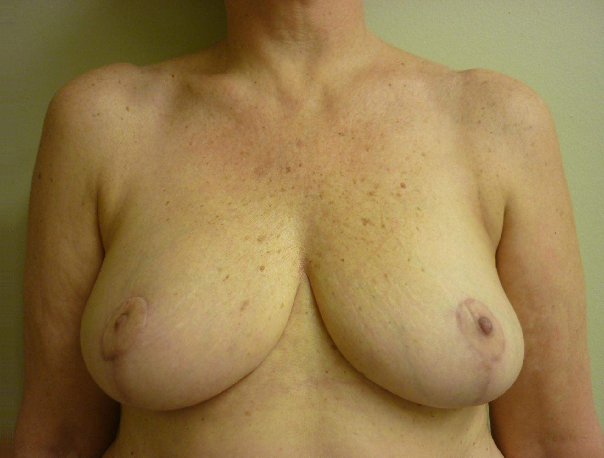 Hurvitz Plastic Surgery breast reduction after — Torrance, CA