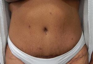 Hurvitz Plastic Surgery tummy tuck after — Torrance, CA