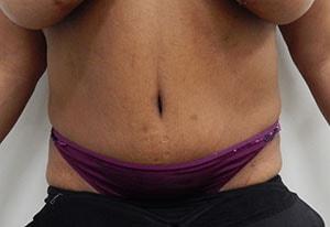 Hurvitz Plastic Surgery tummy tuck after — Torrance, CA