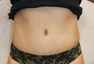 Hurvitz Plastic Surgery tummy tuck after — Torrance, CA
