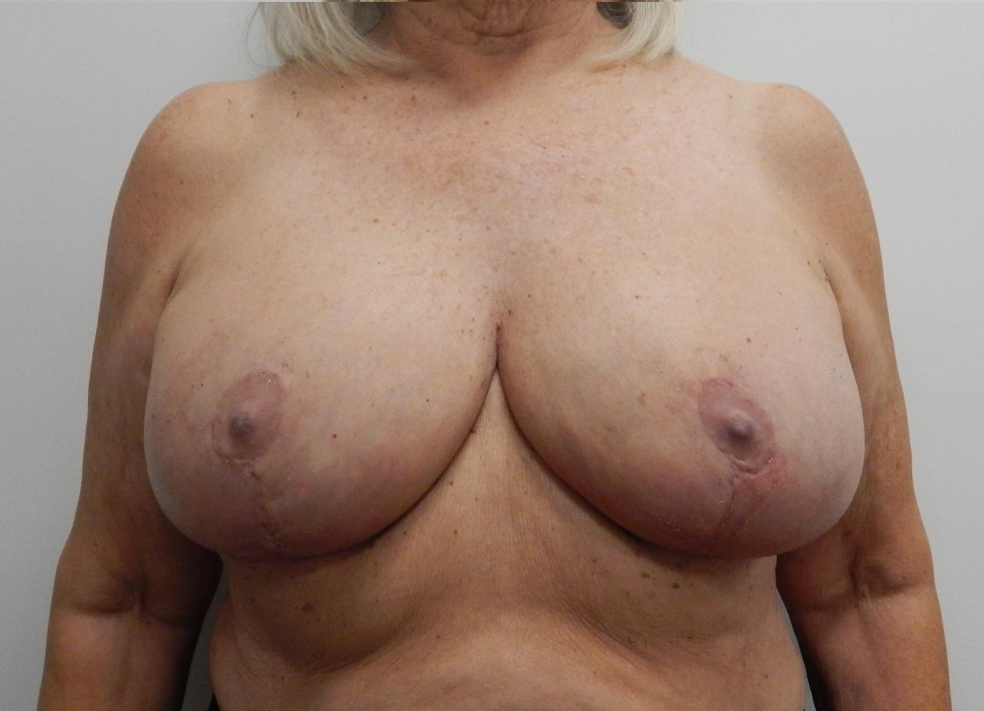 Hurvitz Plastic Surgery breast reduction after — Torrance, CA