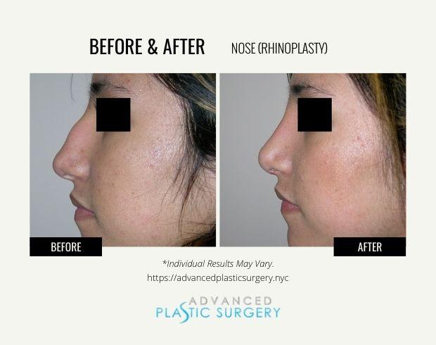 Rhinoplasty result at Advanced Plastic Surgery (Scarsdale) in Scarsdale, NY