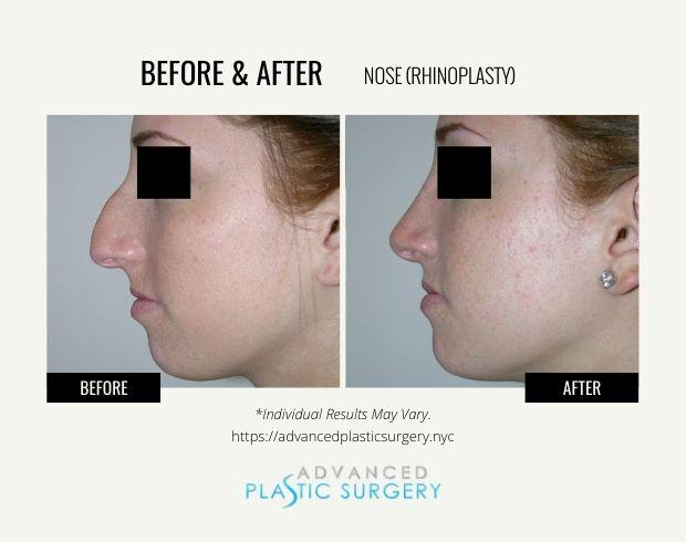Functional Rhinoplasty result at Advanced Plastic Surgery (Scarsdale) in Scarsdale, NY