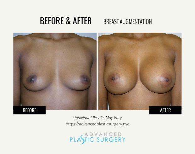 Advanced Plastic Surgery (Scarsdale) breast augmentation result — Scarsdale, NY
