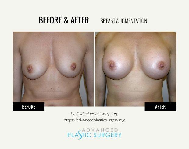 Breast Augmentation result at Advanced Plastic Surgery (Scarsdale) in Scarsdale, NY