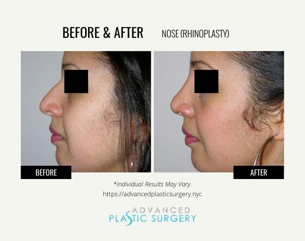 Functional Rhinoplasty result at Advanced Plastic Surgery (Scarsdale) in Scarsdale, NY
