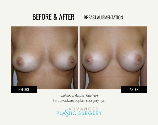 Advanced Plastic Surgery (Scarsdale) breast augmentation result — Scarsdale, NY
