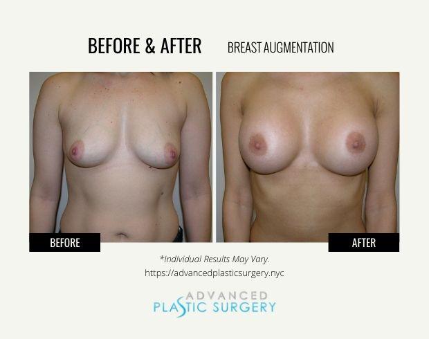 Advanced Plastic Surgery (Scarsdale) breast augmentation result — Scarsdale, NY
