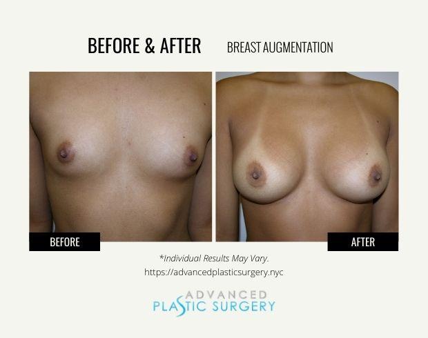 Breast Augmentation result at Advanced Plastic Surgery (Scarsdale) in Scarsdale, NY