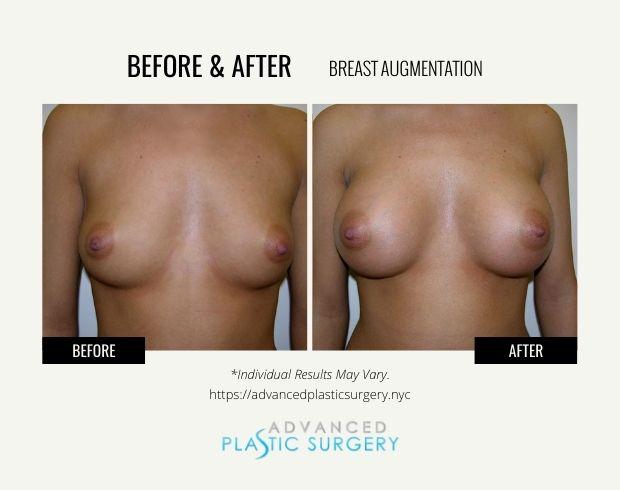 Breast Augmentation result at Advanced Plastic Surgery (Scarsdale) in Scarsdale, NY