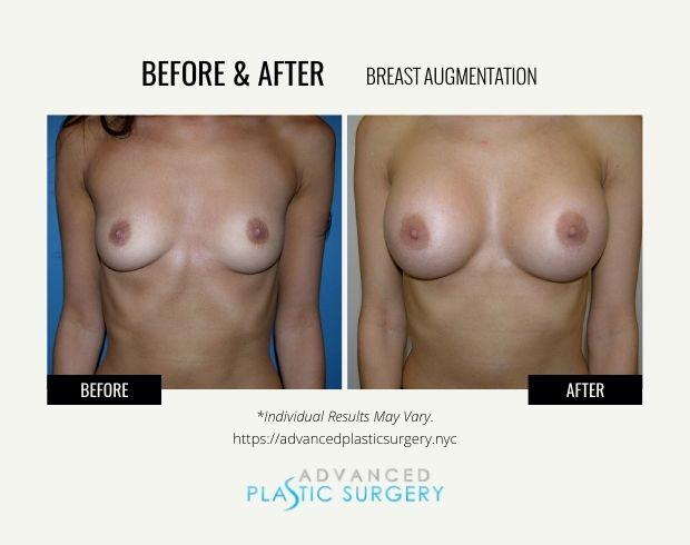 Breast Augmentation result at Advanced Plastic Surgery (Scarsdale) in Scarsdale, NY