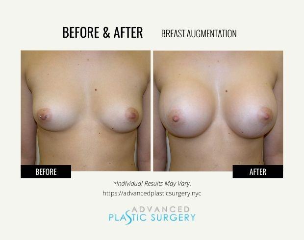 Advanced Plastic Surgery (Scarsdale) breast augmentation result — Scarsdale, NY
