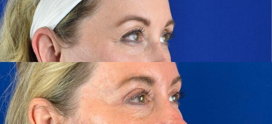 Emmett Plastic Surgery eyelid lift result — Lone Tree, CO