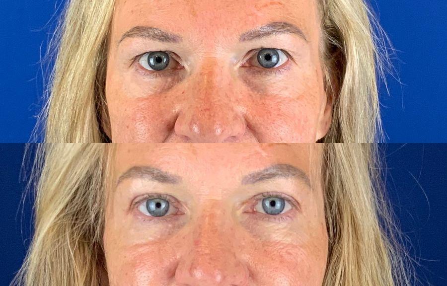 Emmett Plastic Surgery eyelid lift result — Lone Tree, CO