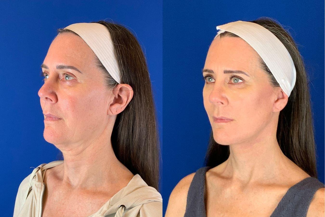 Emmett Plastic Surgery neck lift result — Lone Tree, CO
