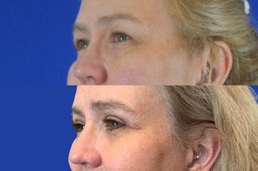 Emmett Plastic Surgery eyelid lift result — Lone Tree, CO