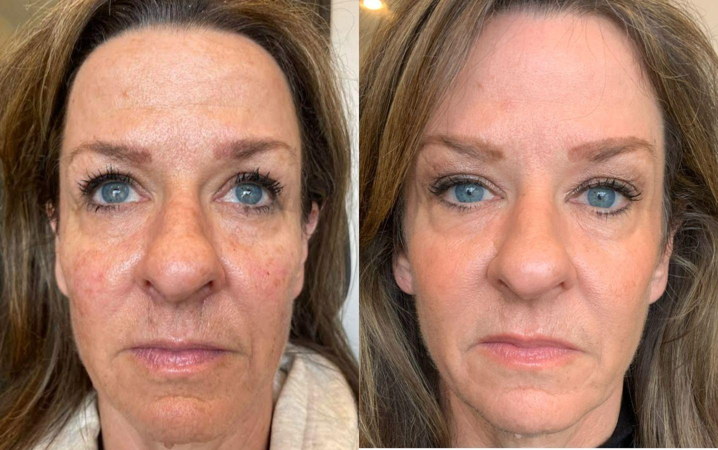 Emmett Plastic Surgery laser treatment result — Lone Tree, CO