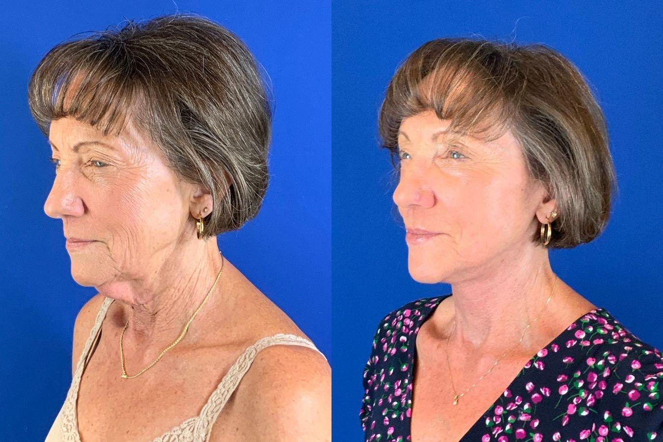 Emmett Plastic Surgery neck liposuction result — Lone Tree, CO