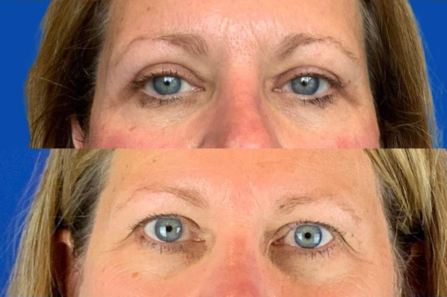 Emmett Plastic Surgery eyelid lift result — Lone Tree, CO