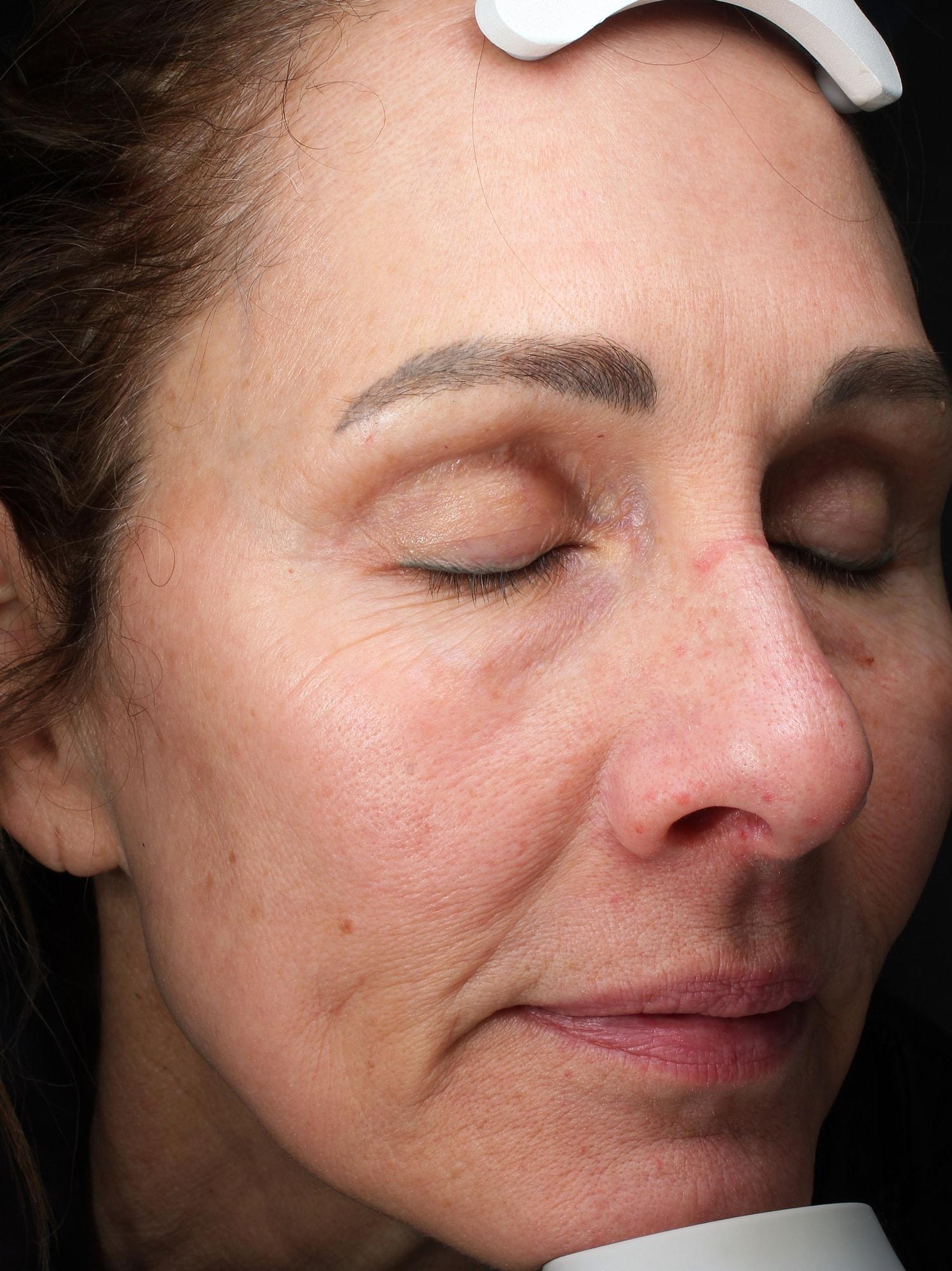 Blush Aesthetics laser treatment after — Columbus, OH