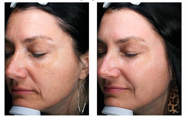 Laser Skin Resurfacing result at Blush Aesthetics in Columbus, OH