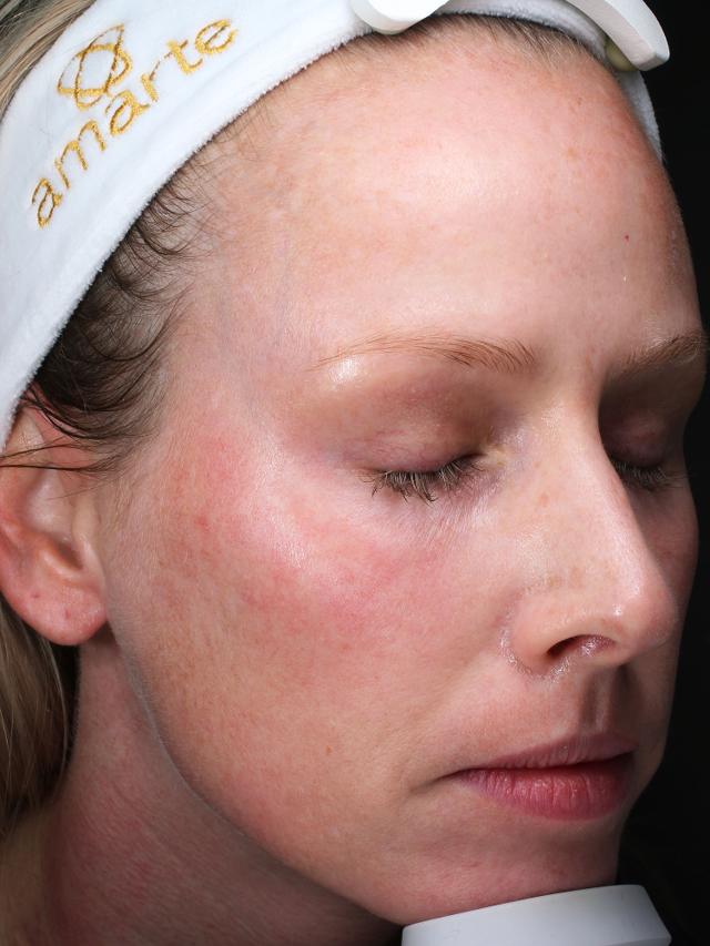 Laser Skin Resurfacing after at Blush Aesthetics in Columbus, OH