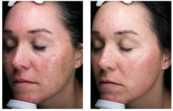 Blush Aesthetics laser treatment result — Columbus, OH
