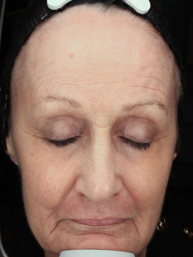 Laser Skin Resurfacing after at Blush Aesthetics in Columbus, OH