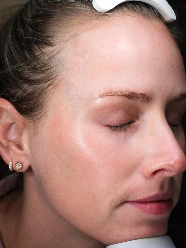Laser Skin Resurfacing before at Blush Aesthetics in Columbus, OH