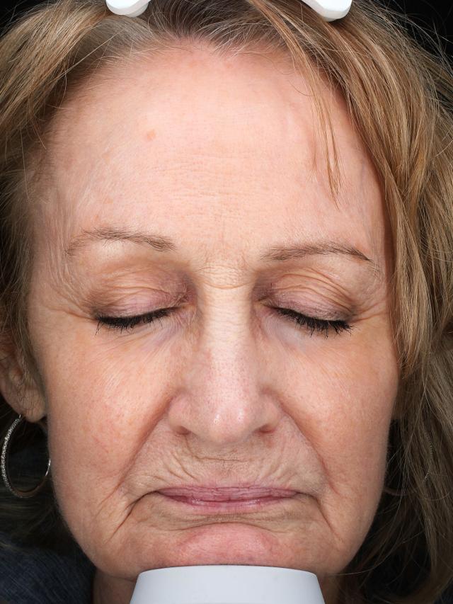 Laser Skin Resurfacing before at Blush Aesthetics in Columbus, OH