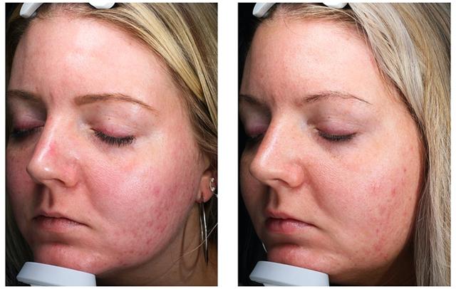 Laser Skin Resurfacing result at Blush Aesthetics in Columbus, OH