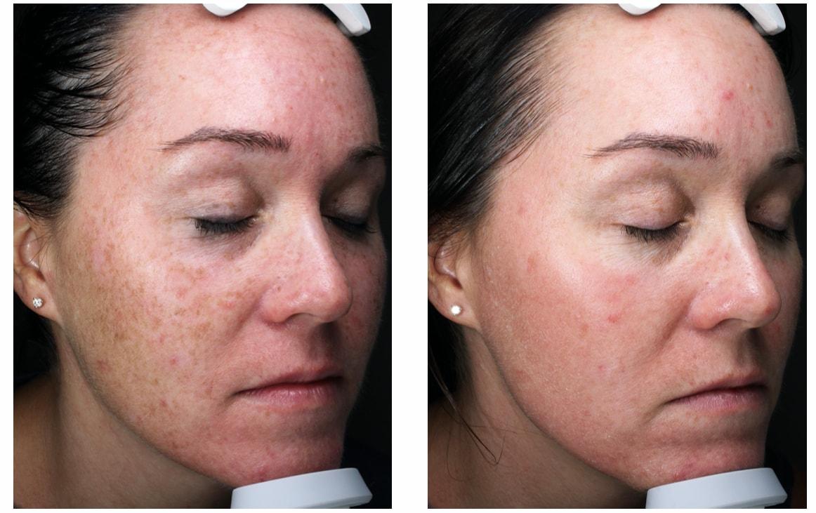 Blush Aesthetics laser treatment result — Columbus, OH