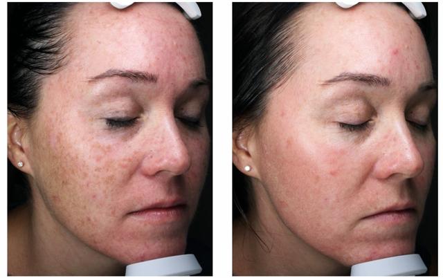 Laser Skin Resurfacing result at Blush Aesthetics in Columbus, OH