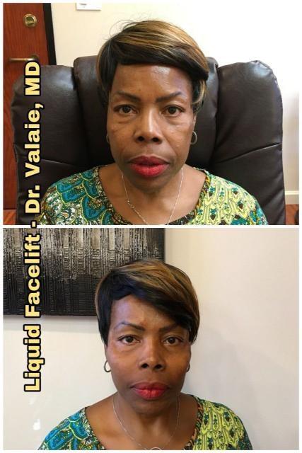 Dermal Fillers result at Dr. Valaie, MD - Cosmetic Surgeon in Newport Beach, CA