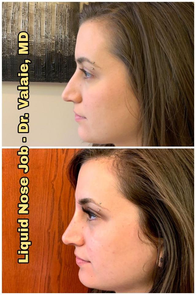Functional Rhinoplasty result at Dr. Valaie, MD - Cosmetic Surgeon in Newport Beach, CA