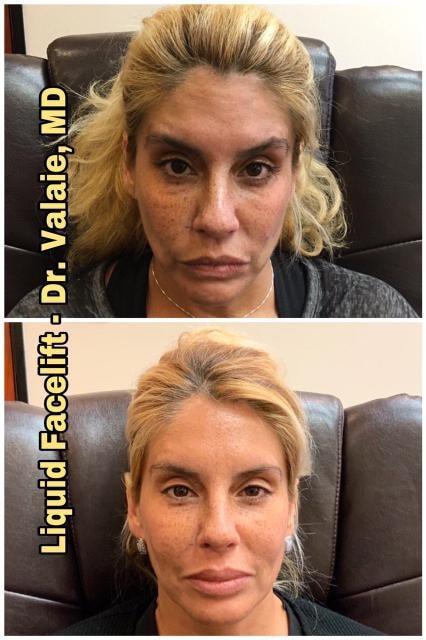 Dermal Fillers result at Dr. Valaie, MD - Cosmetic Surgeon in Newport Beach, CA