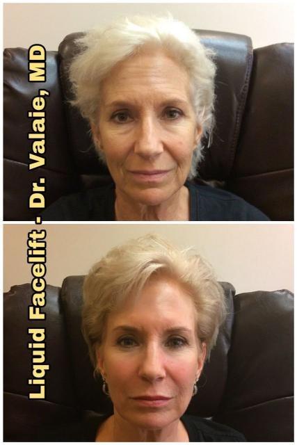 Dermal Fillers result at Dr. Valaie, MD - Cosmetic Surgeon in Newport Beach, CA