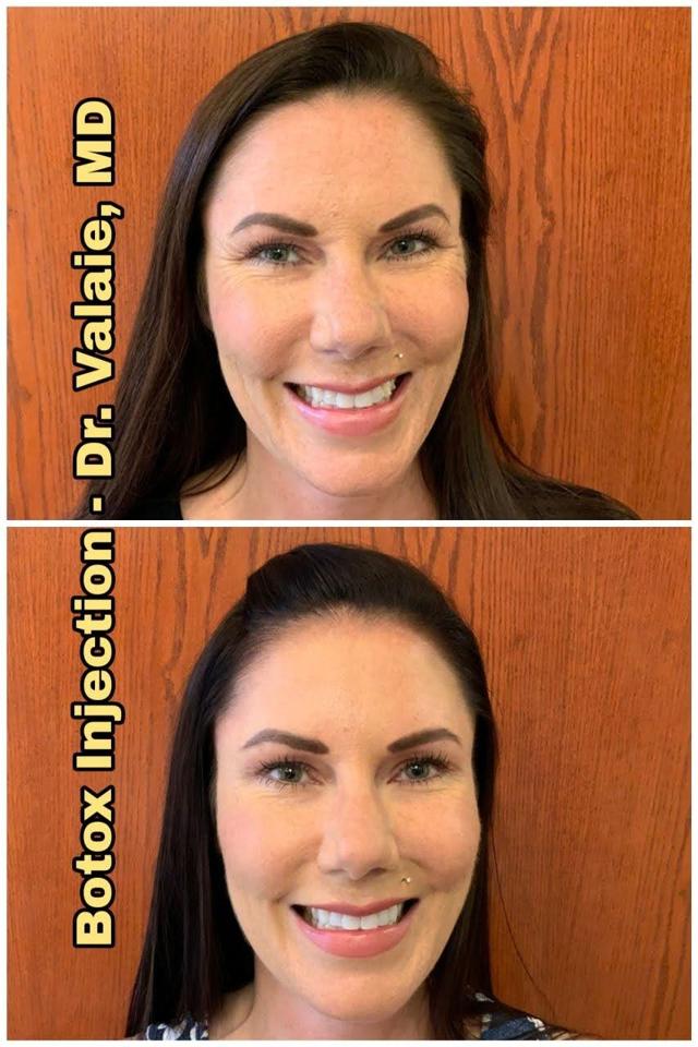 Botox result at Dr. Valaie, MD - Cosmetic Surgeon in Newport Beach, CA