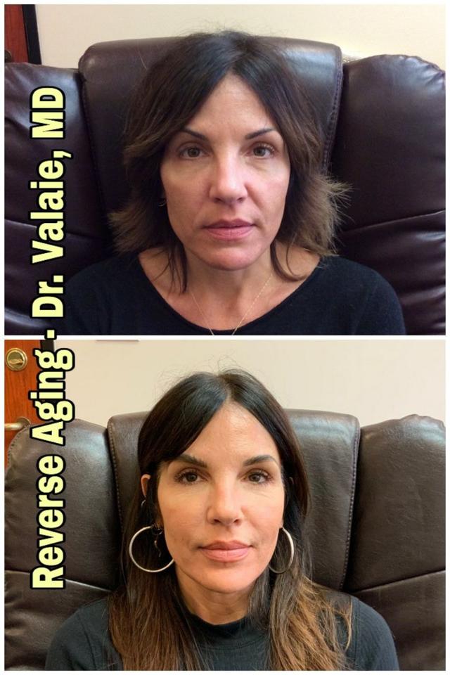 Dermal Fillers result at Dr. Valaie, MD - Cosmetic Surgeon in Newport Beach, CA