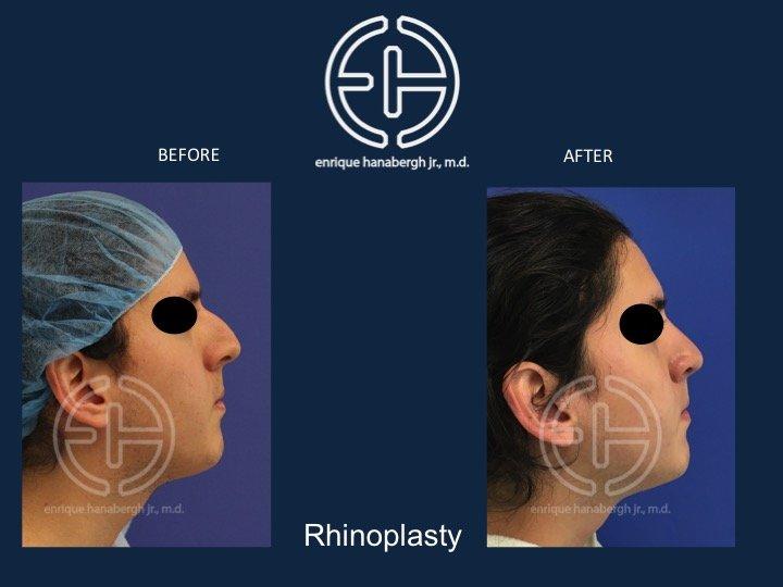 Enrique Hanabergh, MD rhinoplasty result — Miami Lakes, FL