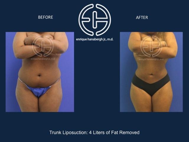Liposuction result at Enrique Hanabergh, MD in Miami Lakes, FL