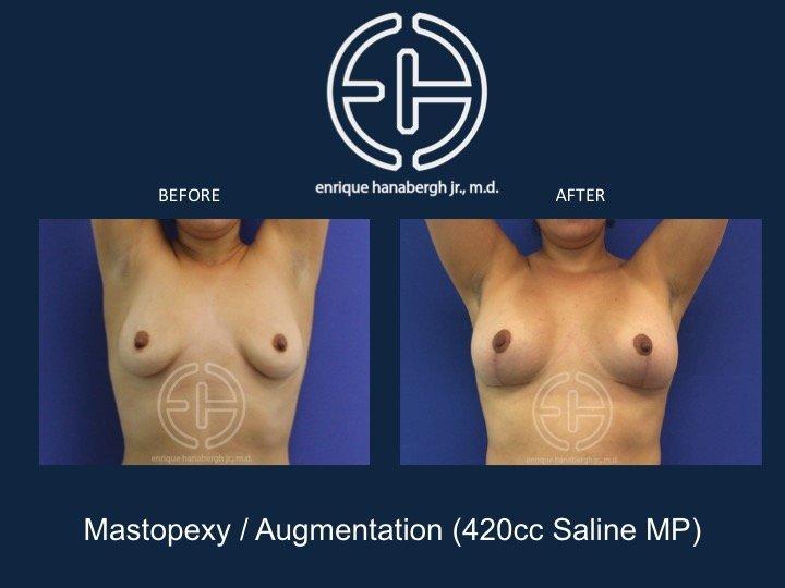 Enrique Hanabergh, MD breast lift result — Miami Lakes, FL