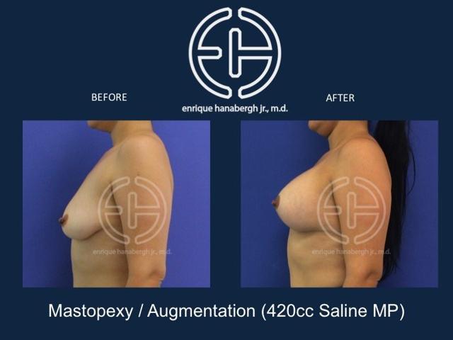 Breast Lift result at Enrique Hanabergh, MD in Miami Lakes, FL