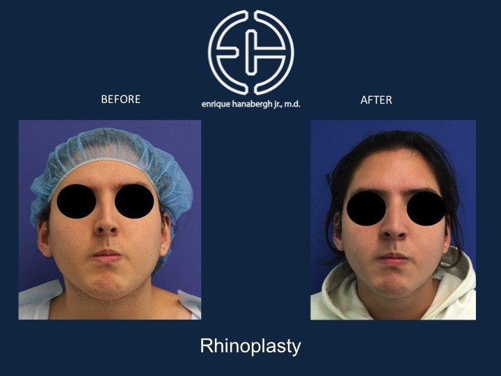 Enrique Hanabergh, MD rhinoplasty result — Miami Lakes, FL