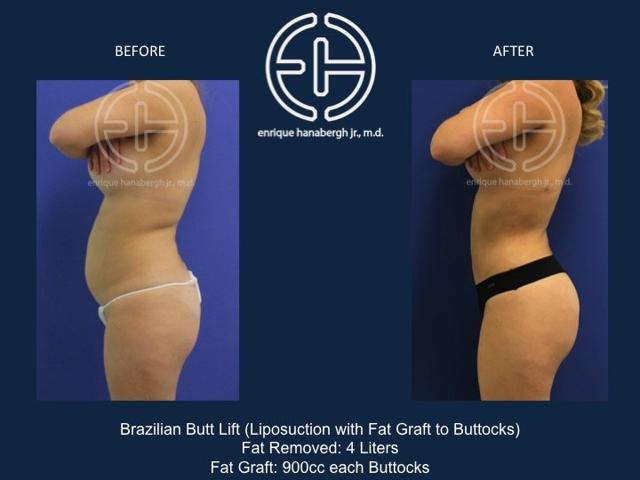 Brazilian Butt Lift result at Enrique Hanabergh, MD in Miami Lakes, FL