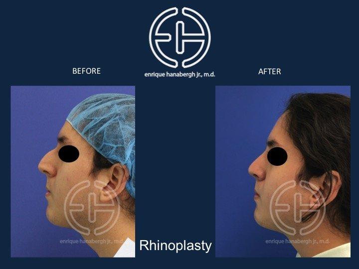 Enrique Hanabergh, MD rhinoplasty result — Miami Lakes, FL